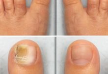 How to Recognize the Signs of Fungal Nails and How to Treat Them