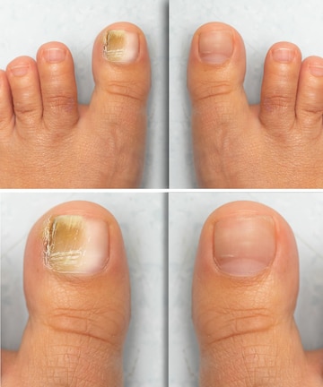 How to Recognize the Signs of Fungal Nails and How to Treat Them